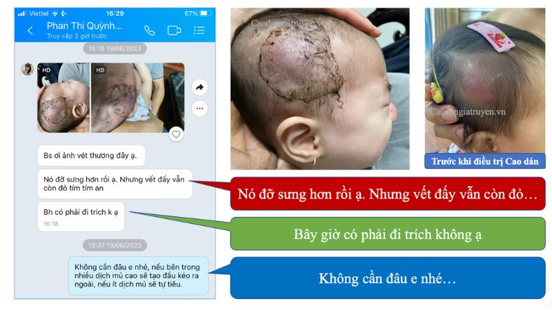 Trẻ bị mụn nhọt trên đầu